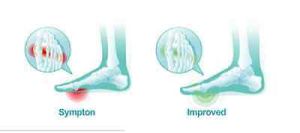 Ортопедична подложка за крака от медицински силикон
